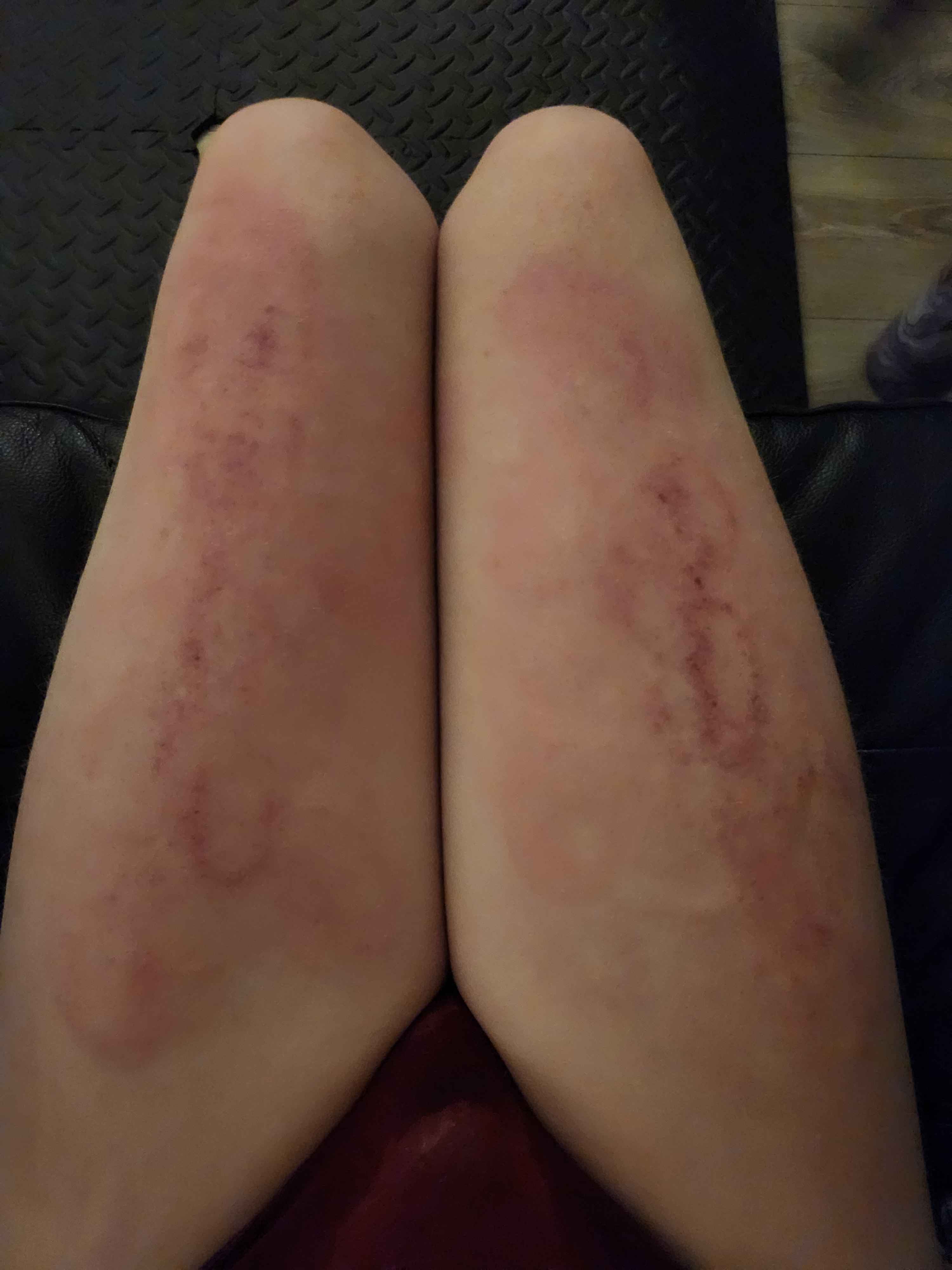 Exquistely Bruised