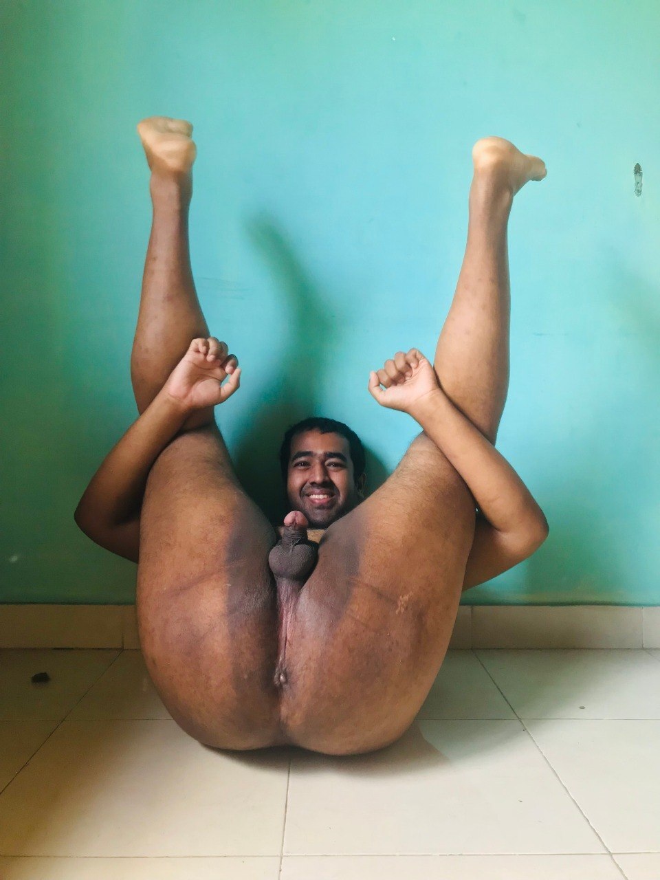 Permanently caged or Free the Micropenis?