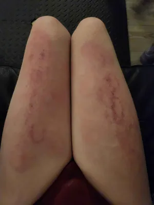 Exquistely Bruised