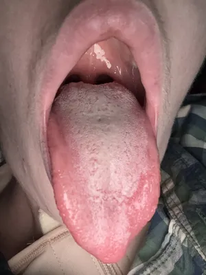rpe my mouth