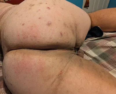 Slightly Red Ass. Once We Pass top 1,000 will redo